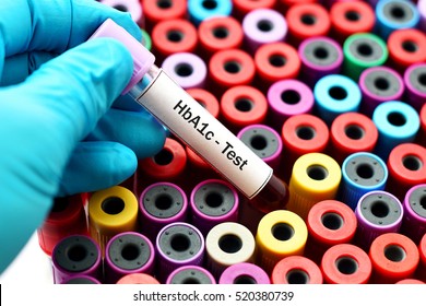 Blood For HbA1c Test, Diabetes Diagnosis