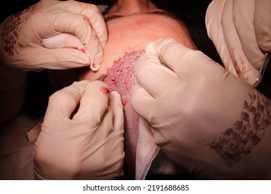 Blood On The Hands And Head Of The Doctors Performing Hair Transplant Surgery