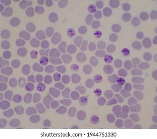 Blutparasit infizierte rote Blutkörperchen Ring von Malaria.