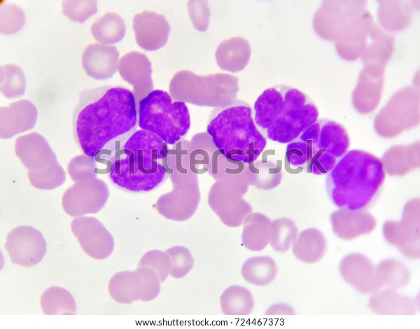 中文 leukemia 慢性粒单核细胞白血病_百度百科