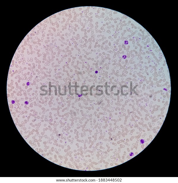 Blood Picture Microcytic Anemia Under Microscope Stock Photo (Edit Now ...