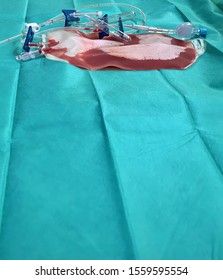 Blood Plasma Out Of A Donors Body With  Stem Cells  Ready For Transfer To The Cancer Patient