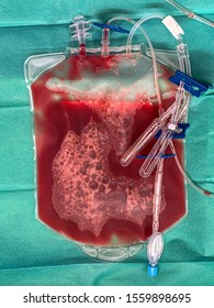 Blood Plasma Out Of A Donors Body With Stem Cells Ready For Transfer To The Cancer Patient 