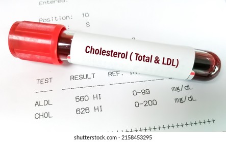 Blood Sample With Abnormal High Report Of Cholesterol Total And Ldl Cholesterol Test.