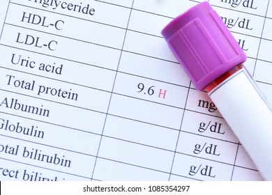 Blood Sample With Abnormal High Uric Acid Test Result