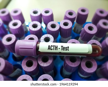Blood sample for Adreno Corticotropic hormone (ACTH) test, diagnosis of adrenal gland problems and pituitary diseases such as Addison's disease, laboratory background.