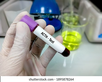 Blood sample for Adrenocorticotropic hormone (ACTH) test, diagnosis of Addison's disease