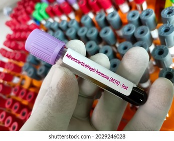 
Blood sample for Adrenocorticotropic hormone (ACTH) test, diagnosis of Addison's disease