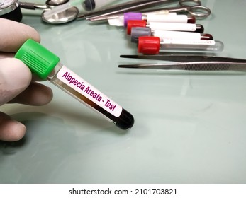 Blood Sample For Alopecia Areata Testing. A Bald Head In A Person. Diffuse Alopecia. Androgenic Alopecia. Hair Loss. Bald Spots On The Head. Trichology