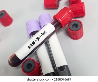 Blood Sample Anti Ss Ro Test Stock Photo 2188076697 | Shutterstock