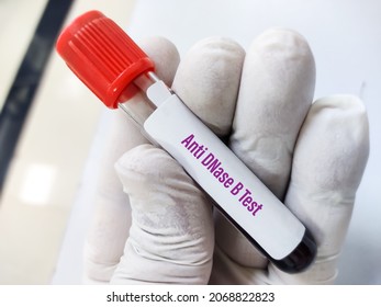 Blood sample for Anti-DNase B or ADN-B test, anti deoxyribonuclease-B antibody, Group A Streptococcus infection