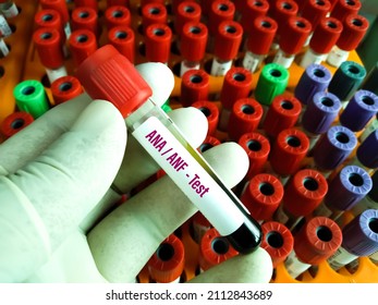 Blood sample for antinuclear antibody (ANA ANF) test, autoimmune diagnosis