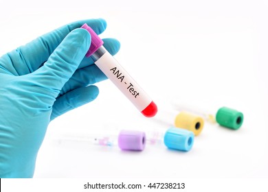 Blood Sample Antinuclear Antibody Ana Test 스톡 사진 447238213 | Shutterstock