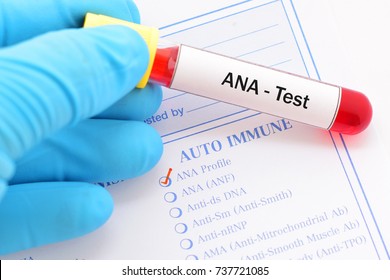 Blood Sample Antinuclear Antibody Ana Test Stock Photo 737721085 ...