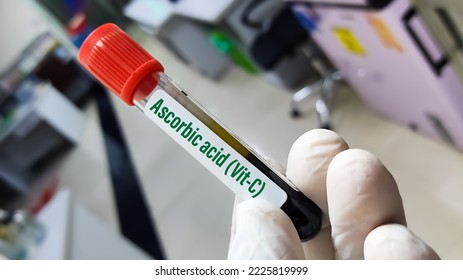 Blood sample for ascorbic acid(vit-C) test. To diagnosis vitamin C deficiency