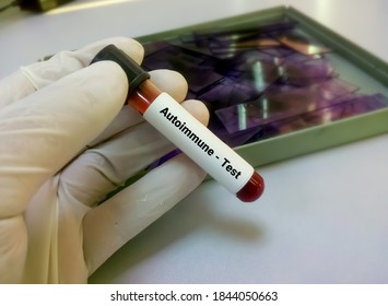 Blood sample for autoimmune disease test. Autoimmune disorder 