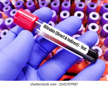 Blood Sample For Bilirubin Direct And Indirect Test. To Diagnosis Of Jaundice