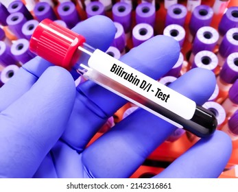 Blood Sample For Bilirubin Direct And Indirect Test. To Diagnosis Of Jaundice