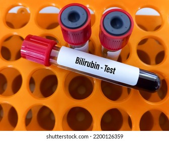 Blood Sample For Bilirubin Test, Liver Function Test.