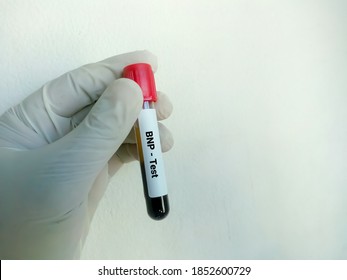 Blood Sample For BNP Test, Cardiac Marker For Acute Or Chronic Heart Failure