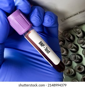 Blood Sample For BNP(Brain Natriuretic Peptide) Test, NT-proBNP Test, BTNP Test, Cardiac Marker For Acute Or Chronic Heart Failure.