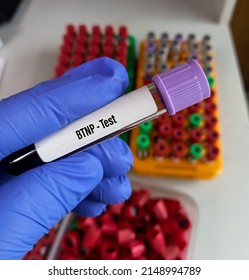 Blood Sample For BTNP(B-type Natriuretic Peptide) Or NT-proBNP Test, Cardiac Marker For Acute Or Chronic Heart Failure, BNP Test.