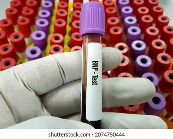 Blood Sample For B-type Natriuretic Peptide Or BNP Test, Cardiac Marker For Acute Or Chronic Heart Failure