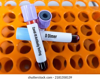 Blood Sample For Covid-19 Antibody And D Dimer Test. Biochemistry Lab Close View. IgG, IgM Test Of Covid-19.