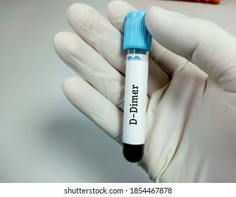 Blood Sample For D-Dimer Test. Coagulation Test