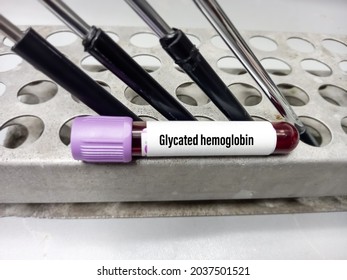 Blood Sample For Glycated Hemoglobin Or HbA1c Test, Diabetic Treatment Monitoring Test