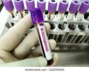 31 Hemoglobin electrophoresis Images, Stock Photos & Vectors | Shutterstock