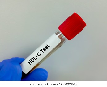 Blood sample for HDL-C (HDL Cholesterol) test, good cholesterol, lipid profile 