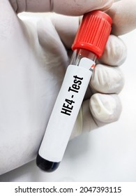 Blood Sample For HE4 (human Epididymis Protein 4 ) Test, Monitoring Epithelial Ovarian Cancer