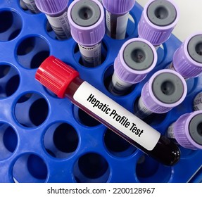 Blood Sample Hepatic Profile Test Liverhepatic Stock Photo Shutterstock