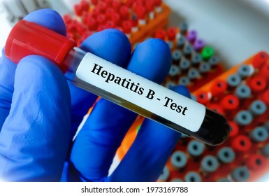 Blood Sample Hepatitis B Virus Test Stock Photo 1973169788 | Shutterstock