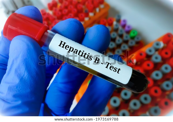 Blood Sample Hepatitis B Virus Test Stock Photo 1973169788 | Shutterstock