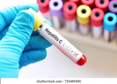 Blood sample with hepatitis C virus (HCV) positive