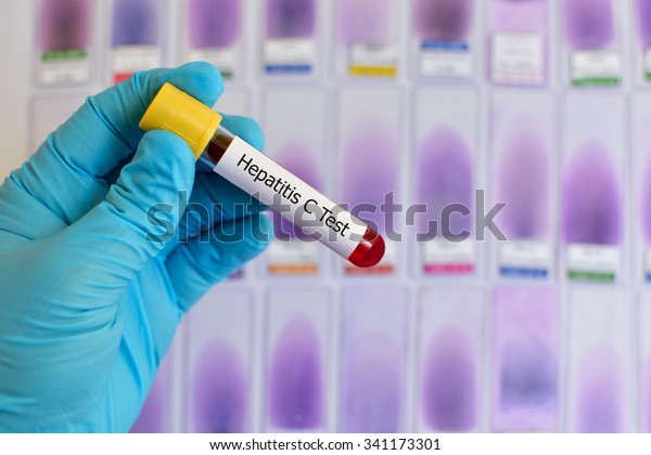 Blood sample\
for hepatitis C virus (HCV)\
testing