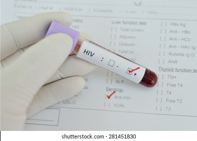 Blood Sample With HIV Positive