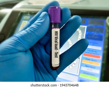 Blood Sample For HIV Viral Load Testing At Medical