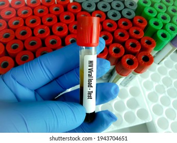 Blood Sample For HIV Viral Load Testing At Medical