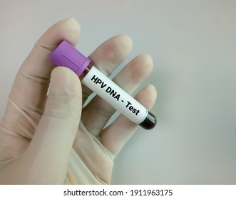 Blood Sample For HPV DNA Test, Human Papilloma Virus, Cervical Cancer 