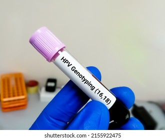 Blood Sample For Human Papillomavirus (HPV) Genotyping Testing In PCR Laboratory