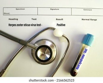 Blood sample for Hunt syndrom test with positive result report sheet. Which is causes for Herpes zoster oticus virus. Hunt syndrome is a painful rash around the ear, on the face, or on the mouth.