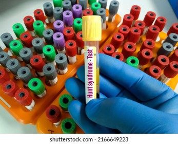 Blood sample for Hunt syndrome test at medical laboratory. Which is causes for Herpes zoster oticus virus.Hunt syndrome is a painful rash around the ear, on the face, or on the mouth.