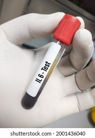 Blood Sample For IL 6 (Interleukin 6) Test, Inflammatory Cytokine, Anti Inflammatory Myokine