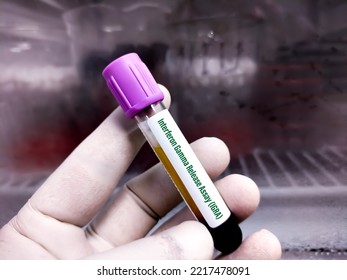 Blood Sample For Interferon Gamma Release Assay (IGRA) Test For Diagnosis Of Tuberculosis