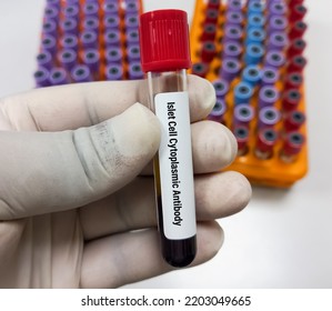 Blood Sample For Islet Cell Cytoplamic Antibody Test. Insulin Ab.