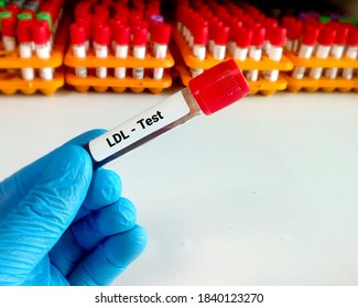 Blood Sample For LDL (low-density Lipoprotein) Test. Lipid Profile. Bad Cholesterol.