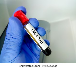 Blood Sample For LDL-C (LDL Cholesterol) Test, Bad Cholesterol